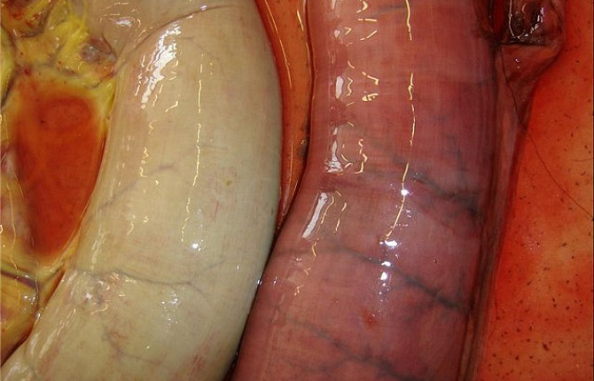 Воспаленный участок толстого кишечника при патологии (справа) и в норме (слева)