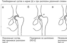 Дисплазия тазобедренных суставов