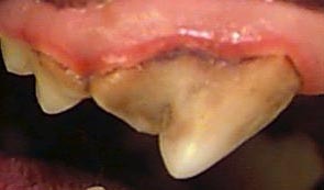 Воспаленная кайма десны возле коронки зубов