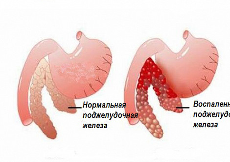 Где Находится Панкреатит У Человека Фото Признаки