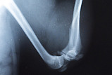 Перелом берцовой кости у собаки фото